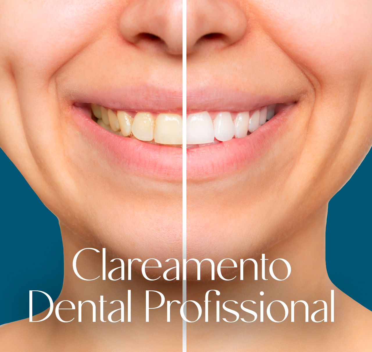 Clareamento dental